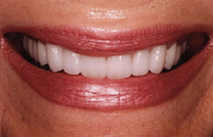 Bright white smile with Empress veneers