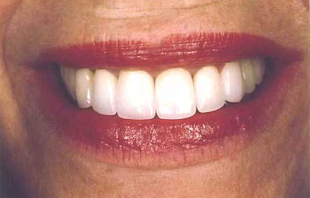 Perfectly repaired front teeth with dental crowns