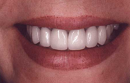 Repaired smile with completely natural looking crown