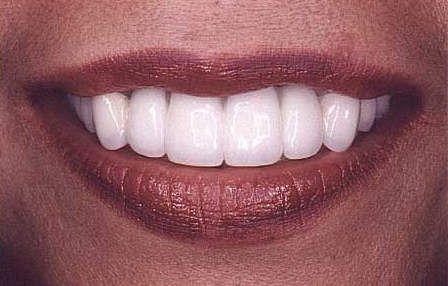 Flawless white smile following veneer and crown restorations