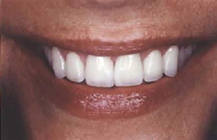 Smile with natural looking bridge and composite restorations