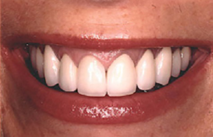 Beautiful smile following gum recontouring and veneers