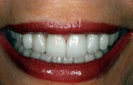 Picture-perfect smile corrected with veneers and crowns