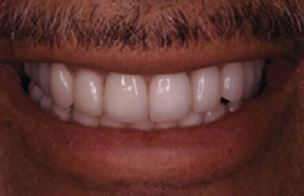 Fully repaired flawless upper and lower teeth