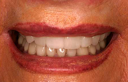 Teeth flawlessly repaired with zirconia crowns