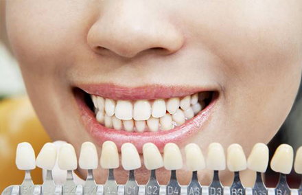 Woman’s smile with color-matching samples in front