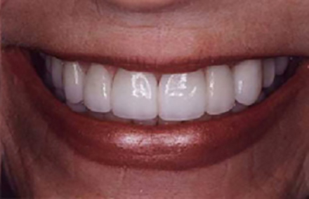 Big smile with perfectly white healthy teeth