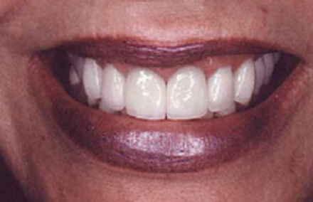 Close up of cosmetically treated smile
