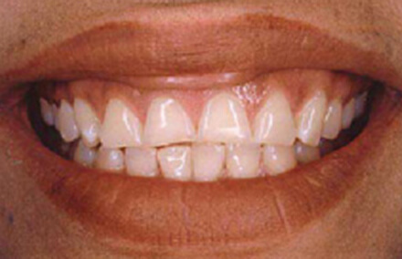 Patient's smile with inflamed gums before treatment