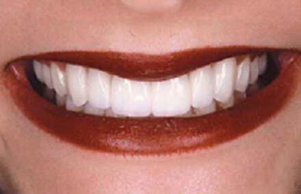 Smile corrected with Empress veneer-crowns and onlays