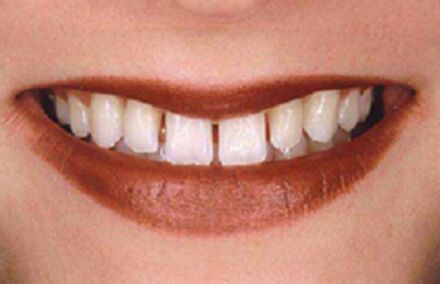 Large gaps between teeth even after orthodontics