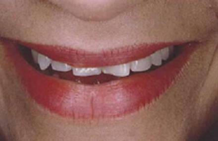 Woman with crooked and interior-facing teeth