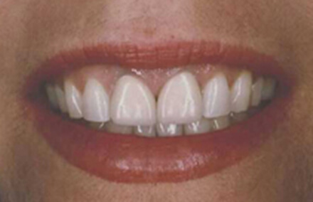 Smile with some wear and chips