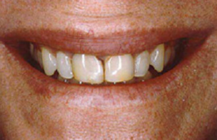 Front two teeth yellowed and decayed