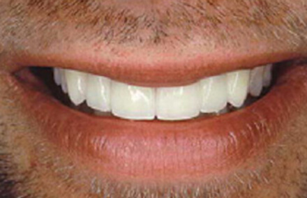Three Empress veneer-crowns perfect a flawed smile