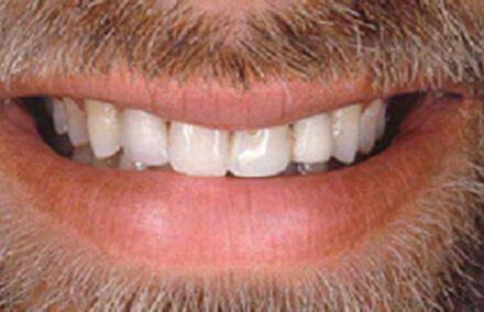 Man's smile with discolored unnatural looking bridge