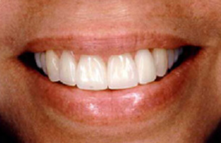 Front four teeth perfected with veneers