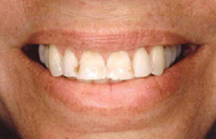 Smile with broken and discolored front four teeth