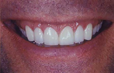 Empress veneers creating a gorgeous smile