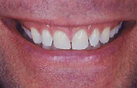 Man with damaged irregularly shaped teeth