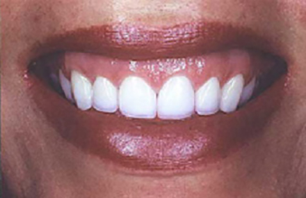 Smile with beautiful natural looking veneers