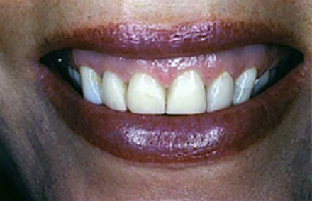 Smile with four older discolored veneers