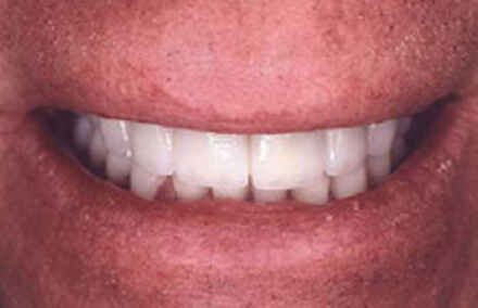 Empress veneer-crowns create a gorgeous smile