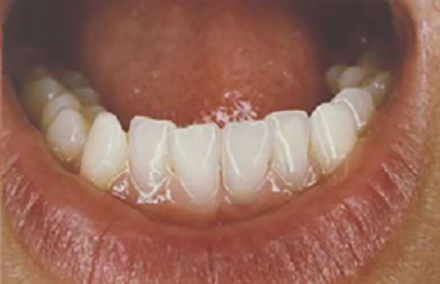 Smile with replaced filling on lower tooth