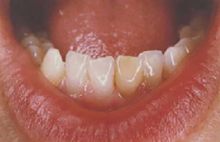 Smile with discolored filling on lower tooth