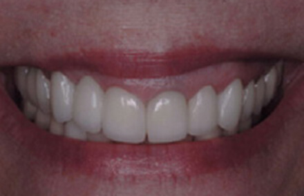 Teeth repaired with natural looking Empress resotrations