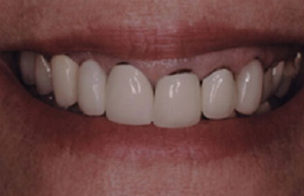 Teeth with dark spots at the gum line