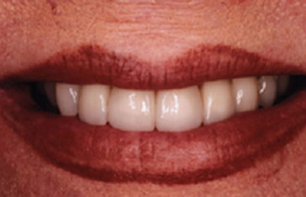 Woman's smile with yellowed teeth
