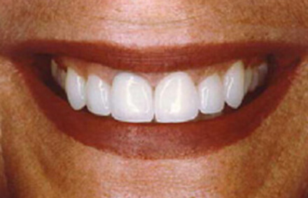 Beautiful smile perfected with porcelain-to-gold restorations