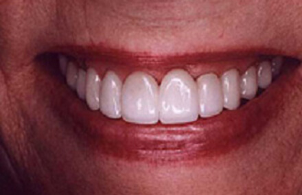 Smile with beautifully crafted and placed Empress veneers