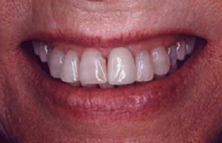 Six front teeth treated with unnatural looking veneers