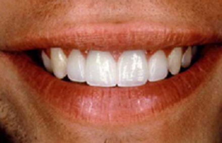 Flawless and evenly sized teeth after smile makeover