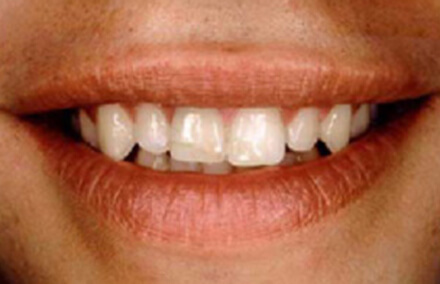 Woman's smile with too-small upper teeth