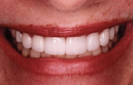 Beautifully restored smile using Empress restorations