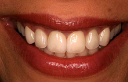 Woman's beautiful smile with Empress veneers