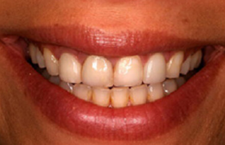 Worn top teeth that don't meet lower row
