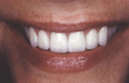 Beautifully restored smile using quality veneers