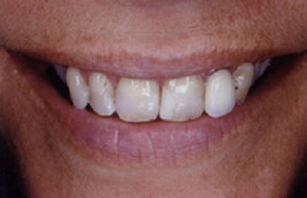 Crooked and discolored smile with old restorations