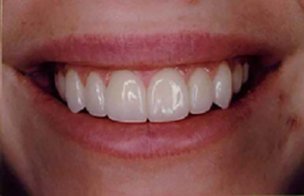 Beautiful smile repaired with porcelain veneers