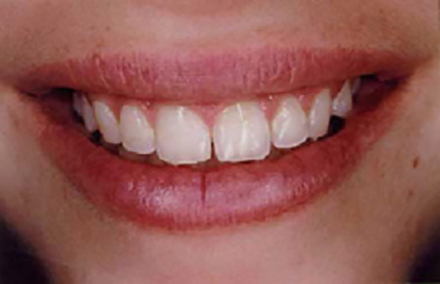 Smile with wear and a gap between front teeth