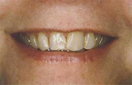 Smile with inconsistently shaped teeth