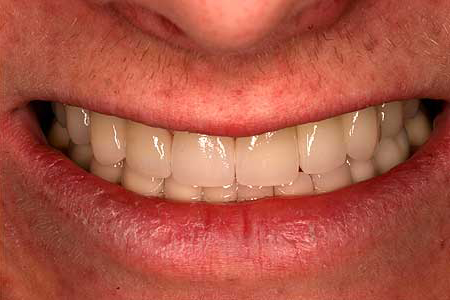 Natural looking replacement teeth and veneer enhancement