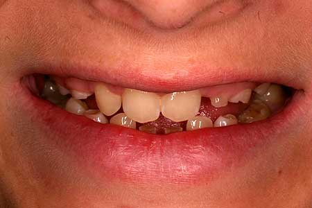 Child's smile with numerous missing adult teeth