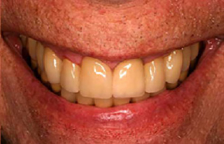 Smile with atural looking porcelain-to-gold crowns