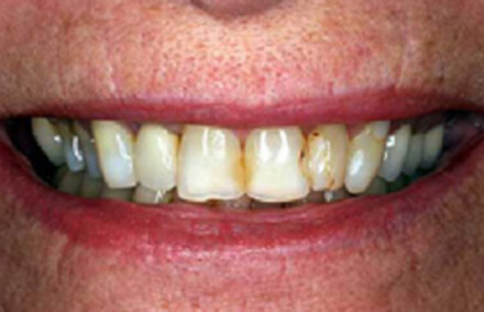 Smile with yellow stains where teeth touch