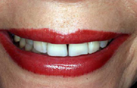Lovely smile with large gaps between teeth